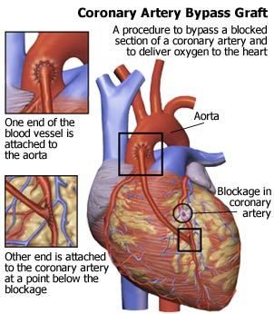 MedFreelancers's tweet image. Watch #Minimally #Invasive #Coronary #Artery #Surgery (#MICAS) by Dr Yugal K Mishra 
goo.gl/xfuvJZ
#heart