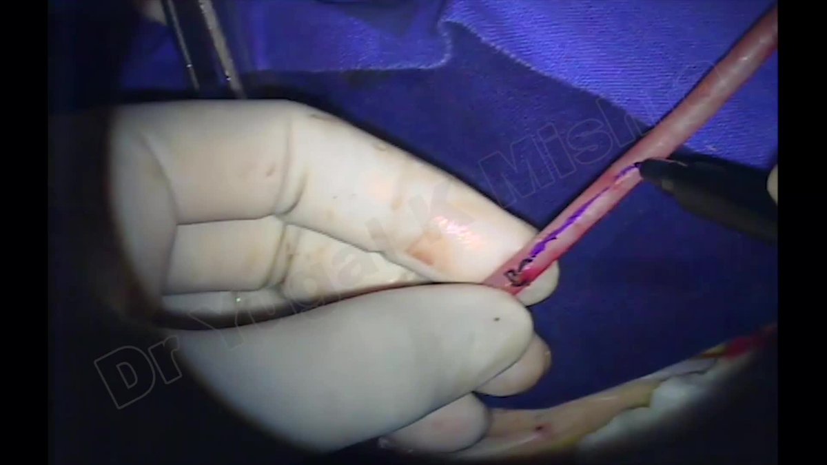 MedFreelancers's tweet image. Watch #Minimally #Invasive #Coronary #Artery #Surgery (#MICAS) by Dr Yugal K Mishra 
goo.gl/xfuvJZ
#heart