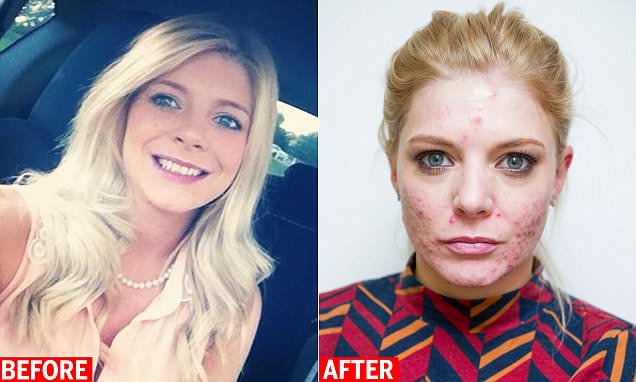 trade_smart_'s tweet photo. Woman is left with facial cysts and acne after having CO2 laser skin treatment https://t.co/iEQv6B8ahj #medworm https://t.co/nyVfRax6Hv
