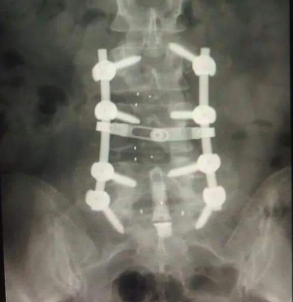 My Lumbar region.  S-1 to L-4. https://t.co/CxtOtqamOv<a href="/tag/fromtheheart"class="tags"><span>#fromtheheart</span></a><a href="/tag/homemadechristmas"class="tags"><span>#homemadechristmas</span></a>
