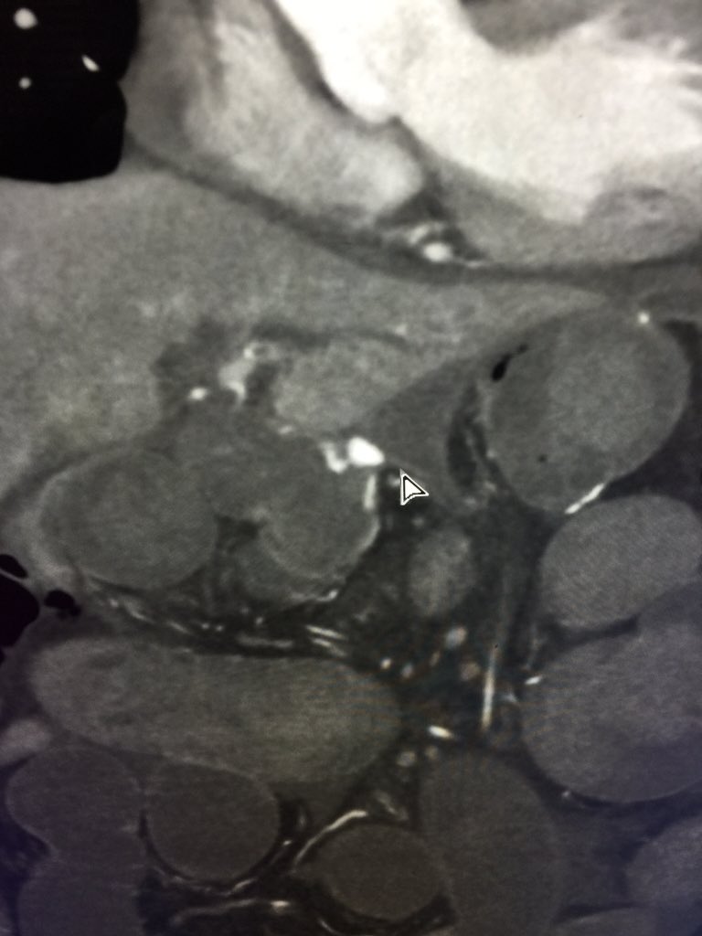 MountSinaiIR's tweet photo. Massive bleed in jejunum post #whipple @MountSinaiNYC St. Lukes #IRad #FOAMIR #justglueit #oncallfun  @bonesz https://t.co/mPBuVWq0fh