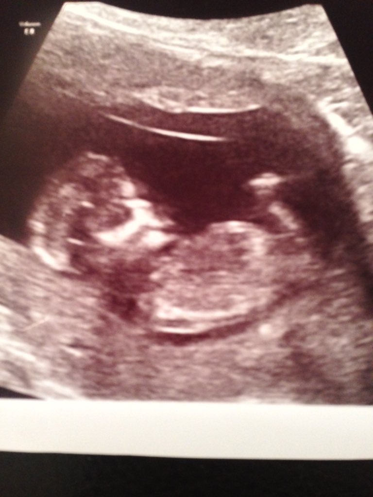 jennifer_powis's tweet photo. Can't wait till August to be a nan for the first time 💗💙 xx https://t.co/1yKqXxlevA