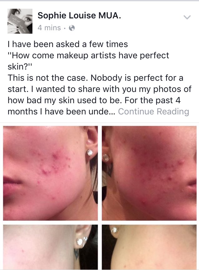 SophsLH's tweet photo. Follow me on Facebook to read about my acne treatment! #acne #treatment #Facebook #mua #sophielouisemua #confidence https://t.co/B7ihAQP258