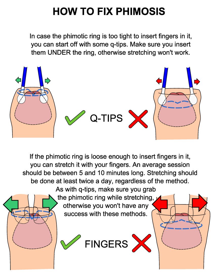 Penis problems | Discharge from the penis