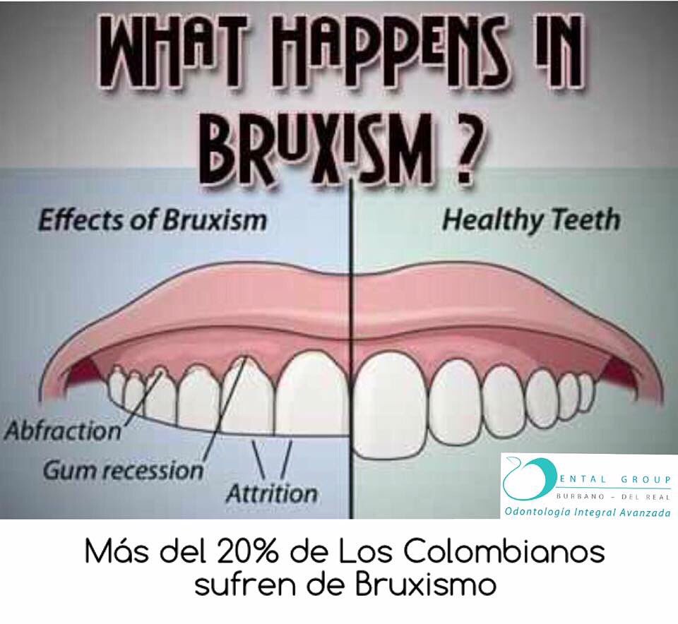 DENTALGROUPbd's tweet photo. #bruxismo 

Tel: 6121508 Bogotá D.C.
Santa Ana Medical Center 
Calle 119# 7-14 cons. 707 https://t.co/wVfFxs2Ymd