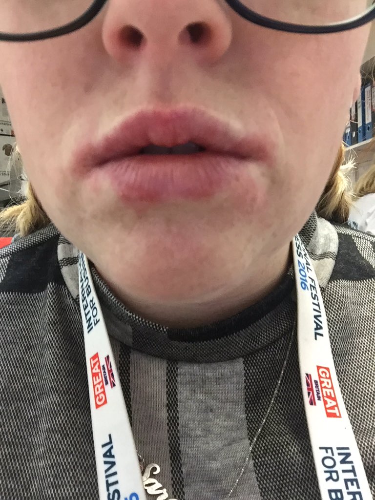 Sarah_Kelly88's tweet photo. So I'm allergic to apples now πππ #ducklips #badtines https://t.co/8ScJoymdxX