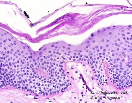 ASDPTweets's tweet photo. "Sandwich sign" is a clue to #tinea infection. #dermpath @GregHoslerMDPhD @MightyDermPath @JMGardnerMD https://t.co/EflEoqpU9n