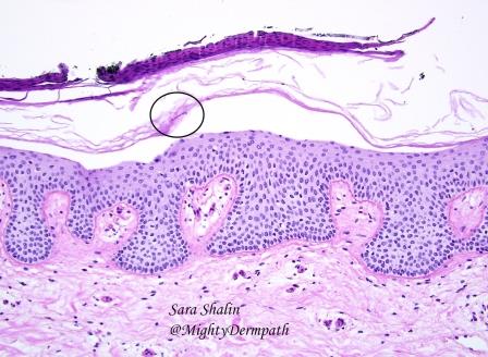 ASDPTweets's tweet photo. "Sandwich sign" is a clue to #tinea infection. #dermpath @GregHoslerMDPhD @MightyDermPath @JMGardnerMD https://t.co/EflEoqpU9n
