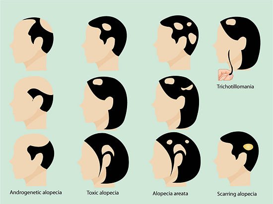 BHHairClinic's tweet photo. There are multiple type's of hair loss! #BHHR #BeverlyHills #HairRestoration #Alopecia #DrKahen #HairLoss #LA https://t.co/D43smhqUKJ