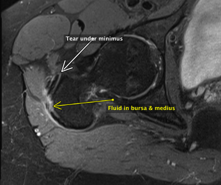 ballaratortho's tweet photo. New Blog David Mitchell: Trochanteric Pain and Gluteal Tears.
https://t.co/D9OgJZB1Ua https://t.co/JdaBpQjmoa