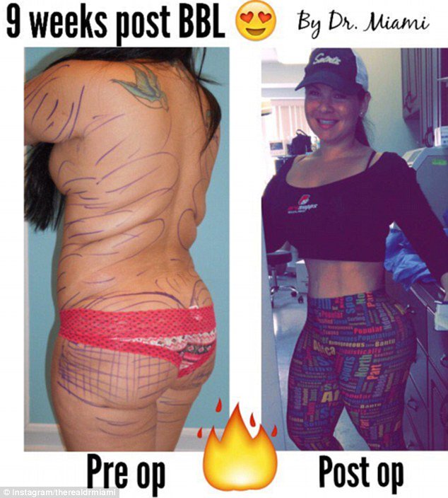 Dr miami finds fame after posting graphic before and after plastic