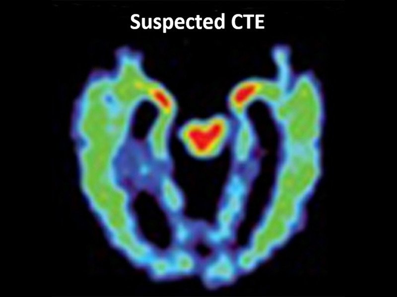 Medscape's tweet photo. Ken Stabler, standout #NFL QB had severe #CTE. Why so many players have this disease - https://t.co/OphX9BtEeQ https://t.co/pNCgNQdf3Z