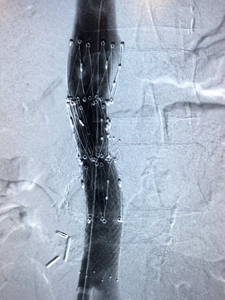 Extrinsic compression from a met node.  Anasarca. Couple of <a href="/cookvascular/">Cook Vascular</a> Z stents should do the trick @Cook_IR