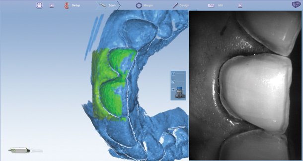 Planmeca's tweet image. Dr. Alex Touchstone: #Digitalimpression margination made easy bit.ly/1SuEnVV #DigitalDentistry #dentistry
