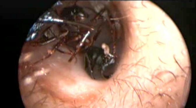 Hiii... Ribuan Semut Bersarang di Telinga Bocah Ini global.liputan6.com/read/2428454/h…