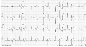 ECGoftheday's tweet photo. This one is from Dr Smiths blog again, great EKG as it is deceiving. @smithECGBlog @prehospECG @jemsconnect @EMS1 https://t.co/kFouwJ5KEj