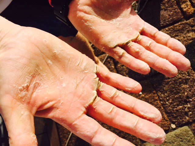 MagnusRJC's tweet photo. @TeamHesco @NorthcottGS sore hands after completing the Atlantic row! Some moisturiser? https://t.co/kE2zJBHOHN