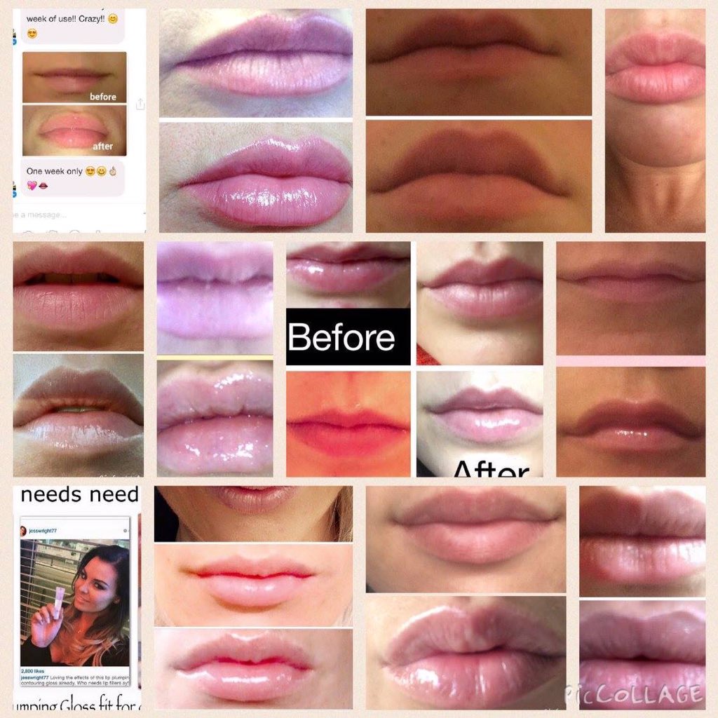 BeauteClare's tweet photo. #pout #perfect #lips #noscaryneedles #kiss https://t.co/bnQ2dPYip7