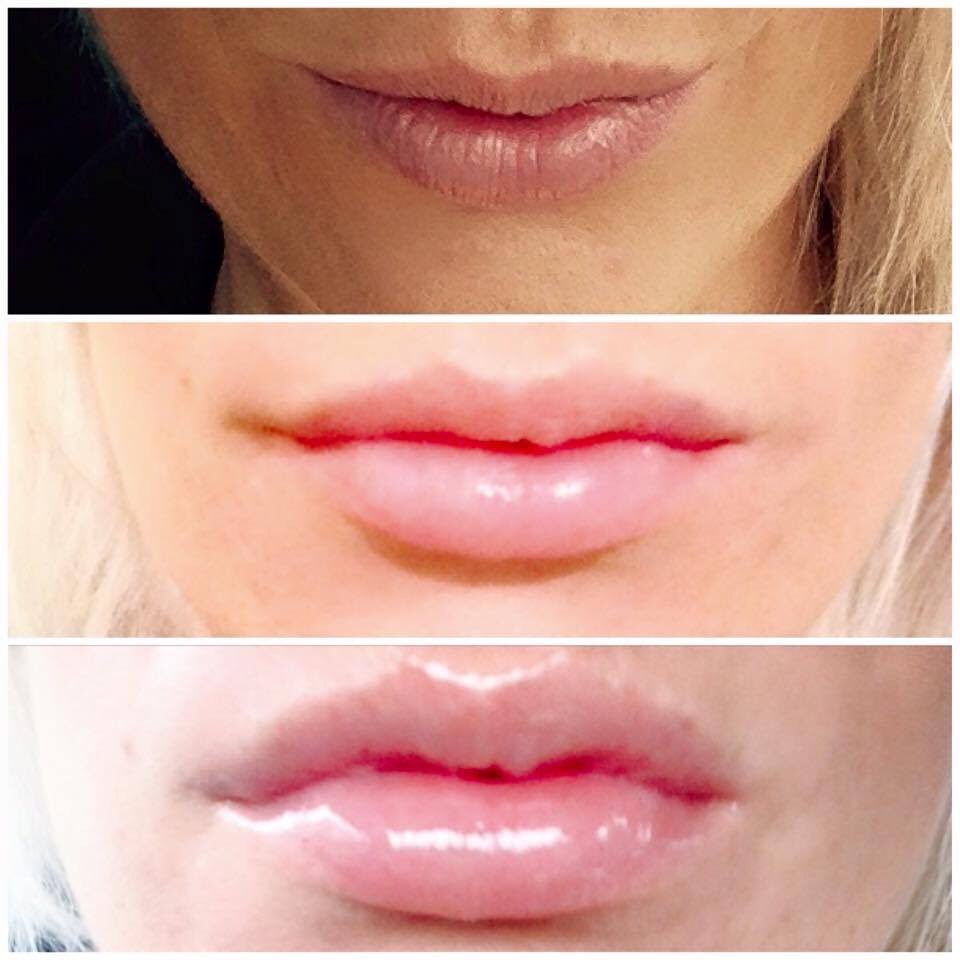 BeauteClare's tweet photo. #pout #perfect #lips #noscaryneedles #kiss https://t.co/bnQ2dPYip7