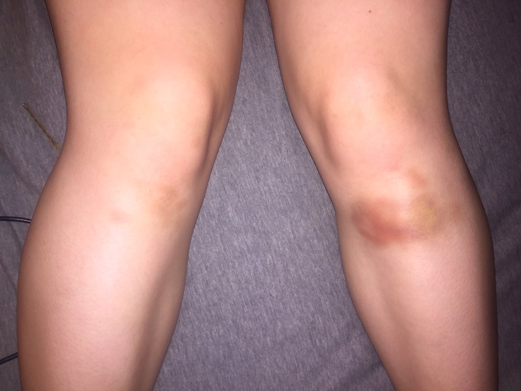 MattieOstlund's tweet photo. Well isn't this just lovely...😒😷💥 #lifeofadancer https://t.co/5tdHnjPjgY