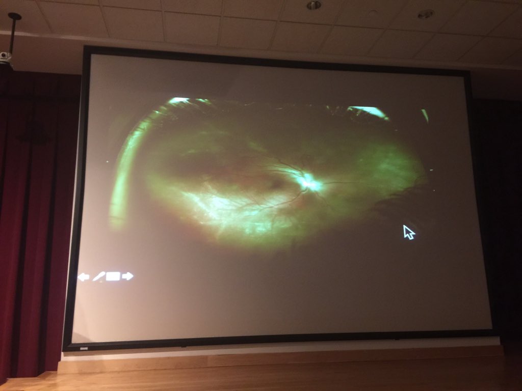 JuliaHallerMD's tweet photo. Tom Jenkins MD @WillsEye optic neuropathy #AcuteRetinalNecrosis diagnostic trail #ChiefsRoundsSleuthing https://t.co/DS18czbw8c