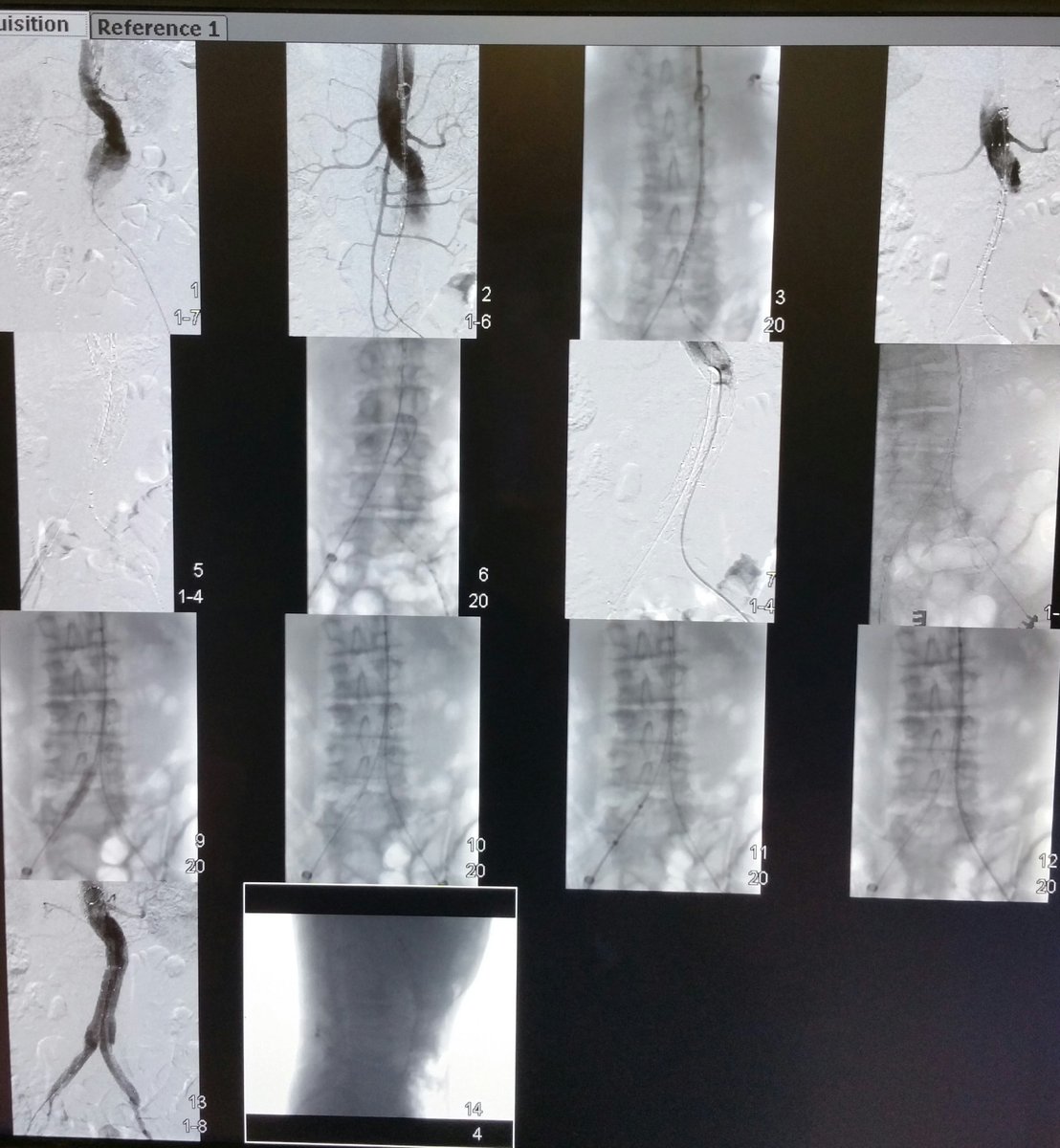 surreyvascular's tweet photo. #EVAR @FrimleyHealth vascular team working together @philipshealth @cardinalhealth @EVtoday @VSGBI #Incraft #XperCT https://t.co/i3soxlGHe4