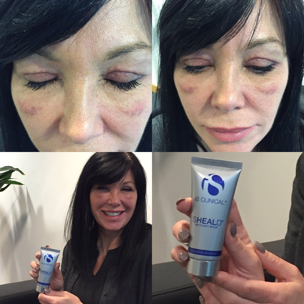 GSDShop's tweet photo. @iSCLINICALUK @iSCLINICAL Product diary day 1 - Tracey starts using iS Clinical Sheald Recovery Balm. #goodskindays https://t.co/kaDrpX7q60