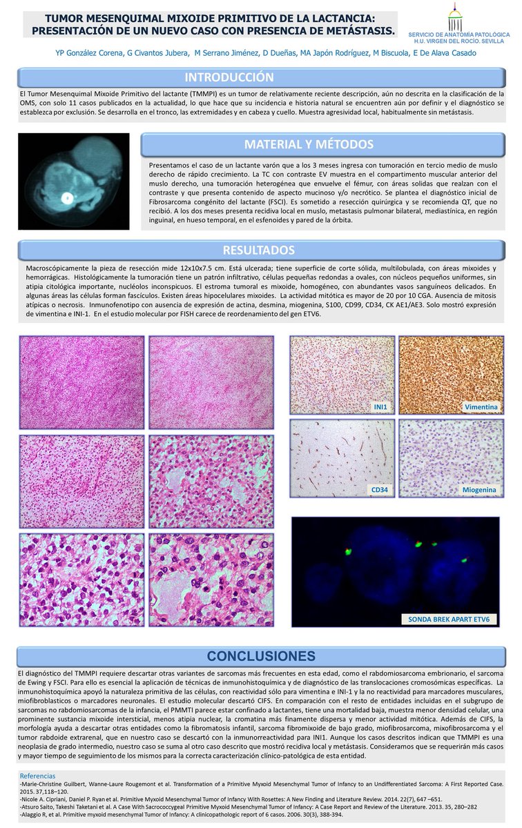 edusqo's tweet photo. "@SEAP_IAP: Gonzalez-Corena YP y col. #SEAP2016 #AnatomiaPatologica. #sarcoma https://t.co/eiQ4XHH7xW" Primitive Myxoid... @JMGardnerMD