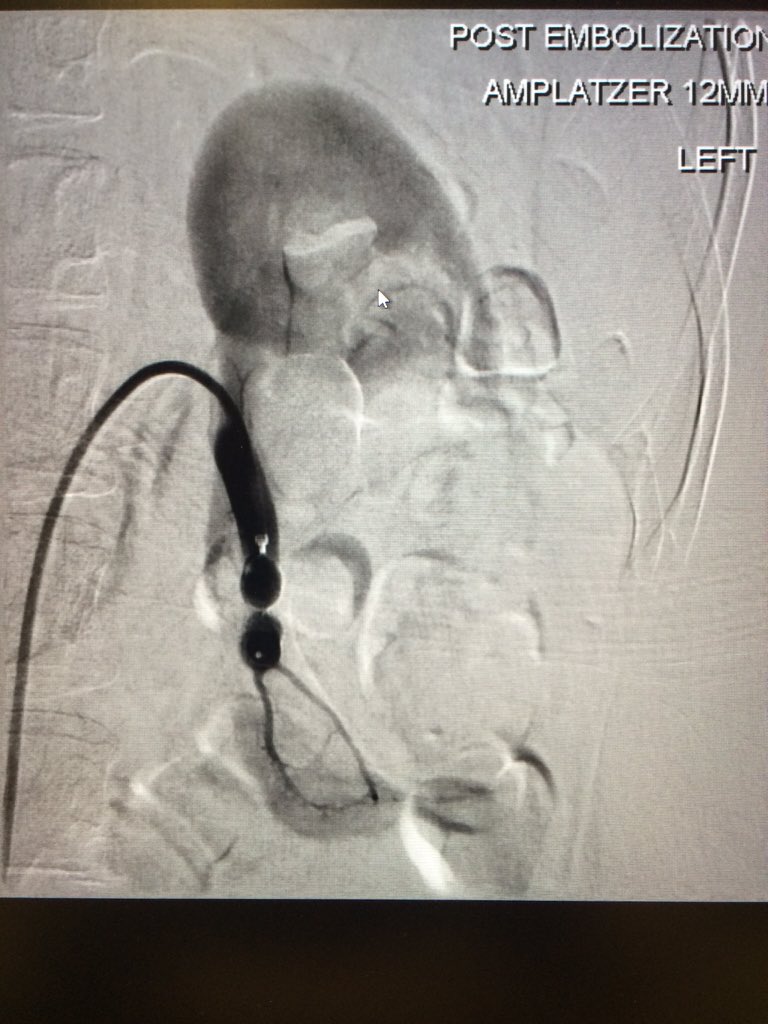 10 cm left Renal AVF @albany_ir <a href="/SIRRFS/">SIR RFS</a> #irad #foamir #justplugit