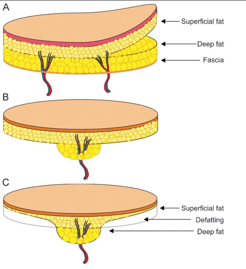 drbernardlee's tweet photo. Thin TDAP flap for reconstruction by @Jp_Joonpio_HONG in @JRM_JRMOpen #microsurgery https://t.co/FilxdmbBZZ https://t.co/S5C2ZnOVmp