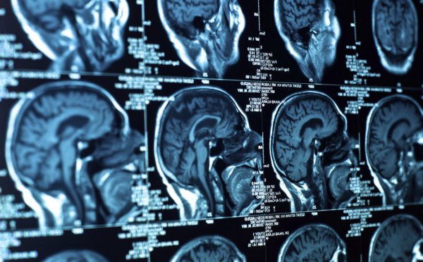 medicxtreme's tweet photo. Enfermedad Vascular Cerebral ¿Isquemia o Hemorragia?: El siguiente artículo fue... https://t.co/2hhLWUib1t https://t.co/iiEhmw2OPW