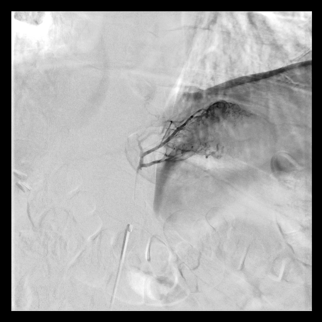 LGA embo for bariatric patients; the next frontier. Excited to move it forward <a href="/SIRRFS/">SIR RFS</a> <a href="/SIRspecialists/">Society of Interventional Radiology</a> <a href="/JVIRmedia/">JVIR</a>