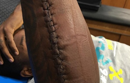 espn's tweet photo. ICYMI: Thomas Davis was Carolina's second-leading tackler last night. Playing with THIS arm. https://t.co/r1I7b3Kdkm https://t.co/QNC8x6V2Gs