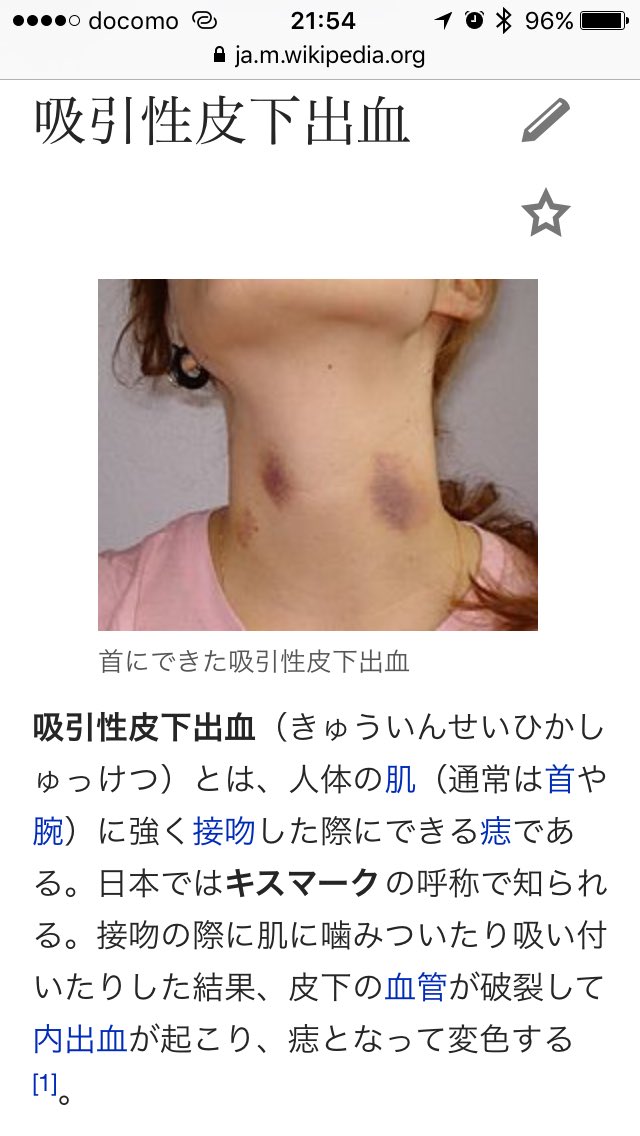 キスマークついてんじゃん 正確には 吸引性皮下出血じゃん だから 血管破裂して内出血起こしてるから Togetter キスマークついてんじゃん 正確には 吸引性皮下出血じゃん だから 血管破裂して内出血起こしてるから Togetter