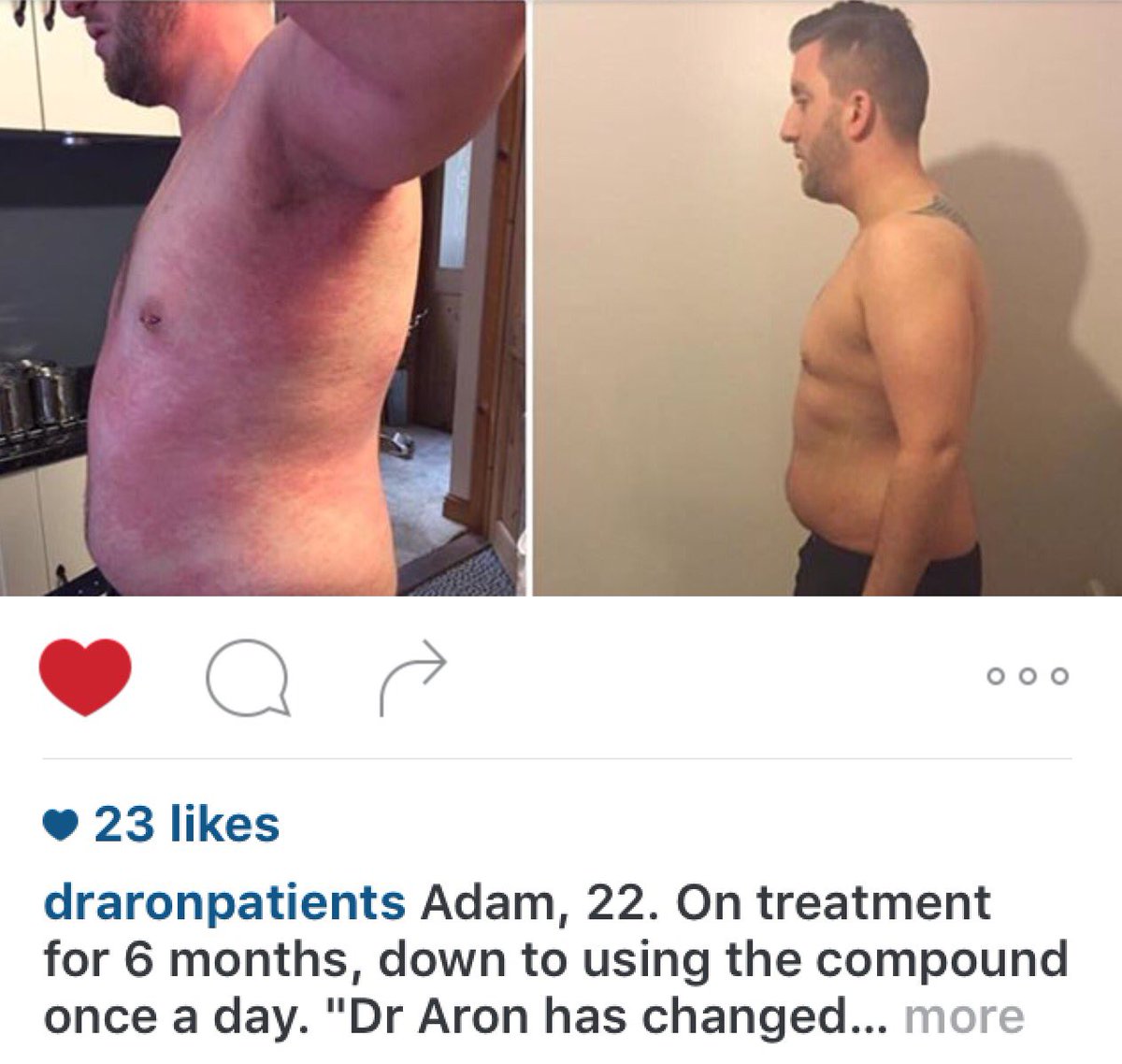 DrAronEczema's tweet photo. Link to post->https://t.co/TJ7vDSoMS4 #DrAron #Dermatologist #AtopicDermatitis #EczemaRelief #Eczema #BeforeAndAfter https://t.co/KUFmF0gLjg