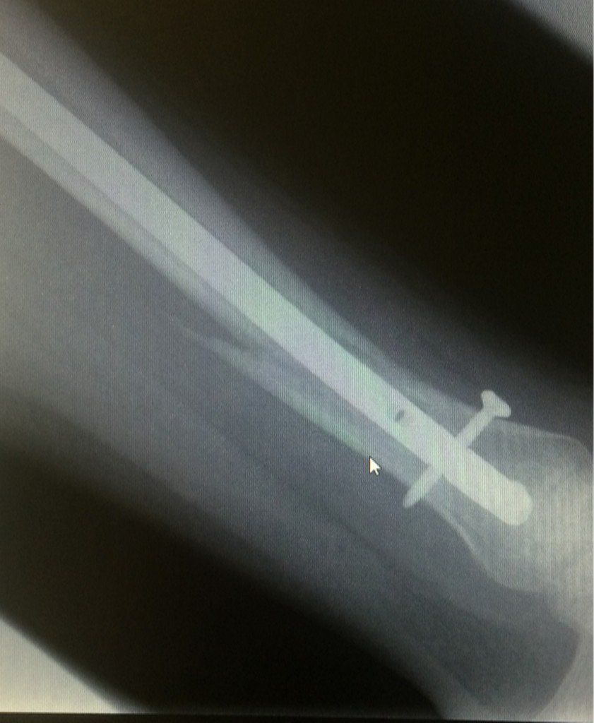 DumbResident's tweet photo. Have been away from Twitter 4 a while bc of a bad accident but doing much better now..  ❤️ ortho surg and PT!#FOAMed https://t.co/5SW4GFPSlh