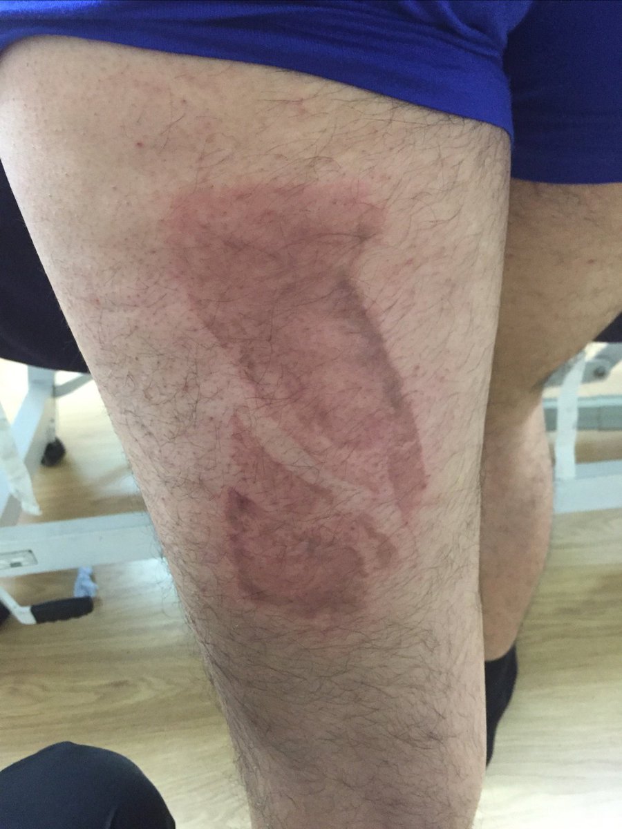 PinnacleFH's tweet photo. #Hamstring #strain or a #tear? What's the difference and how can you tell?
#pinnaclefh #fitness #sportsinjury #in... https://t.co/0PoZHVMCmi