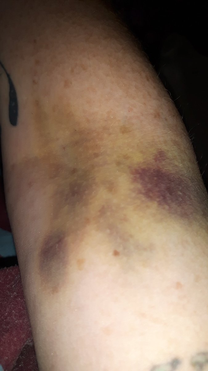 vodkademon's tweet photo. State of my arm from the hospital trying to put a line in my arm to give me morphine they blew a vain ouchy https://t.co/e63zBgDIi3