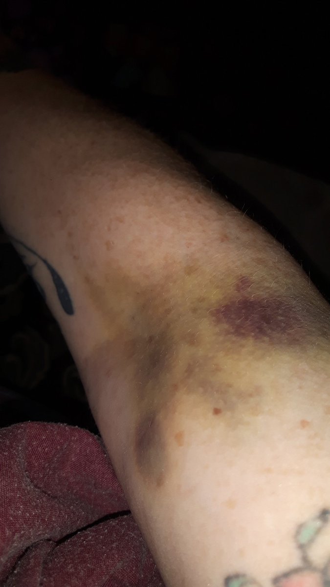 vodkademon's tweet photo. State of my arm from the hospital trying to put a line in my arm to give me morphine they blew a vain ouchy https://t.co/e63zBgDIi3
