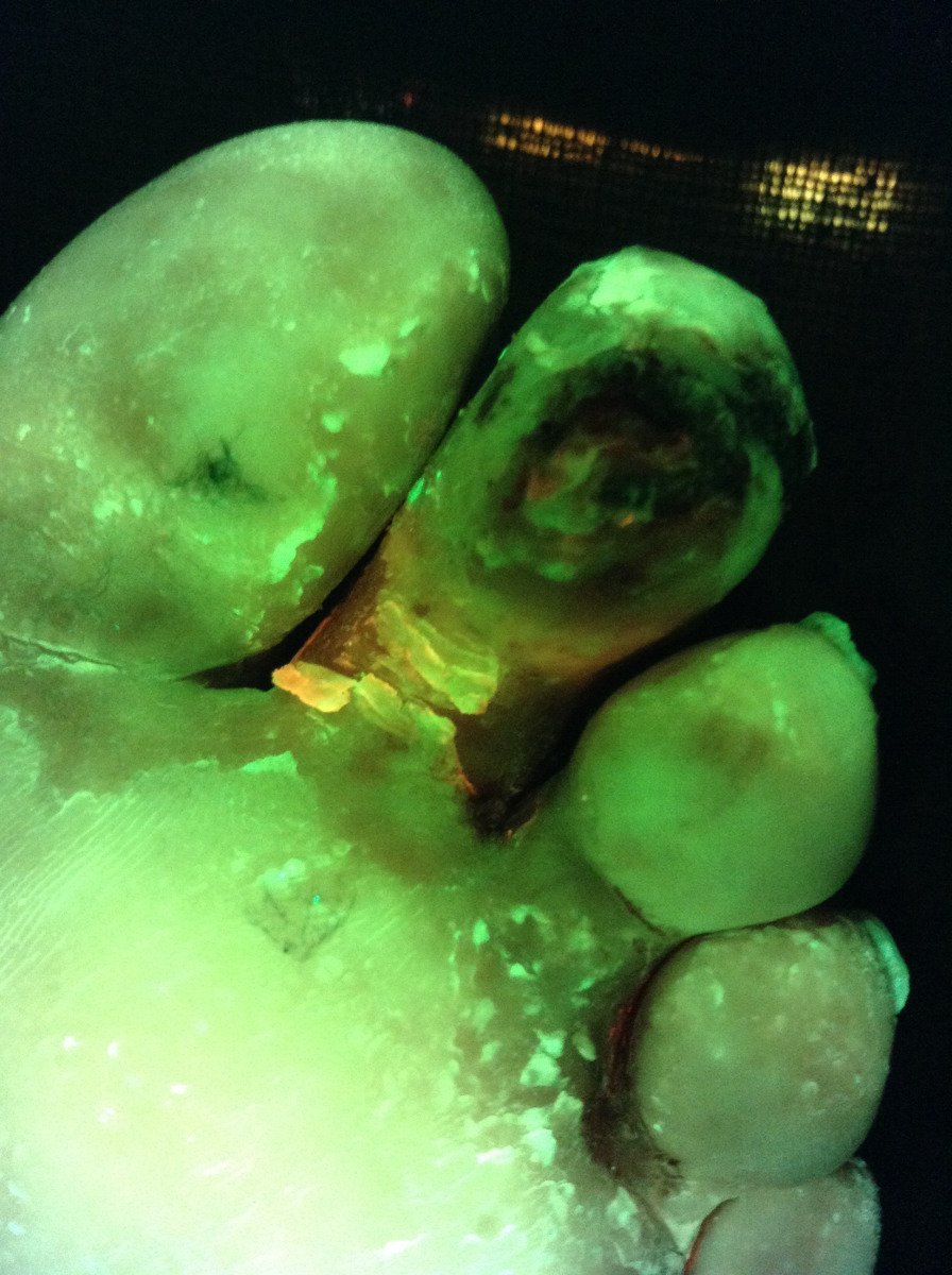 DGArmstrong's tweet photo. 5% of people with New Diabetic Foot Ulcer Die in the 1st Year. 42% in 5 years. @APMAtweets https://t.co/MlyoRAMhxR https://t.co/NNTq7B4w8b