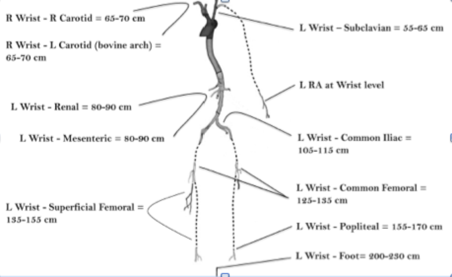 MUSCVIR's tweet photo. Important considerations for radial access #iRad.  If possible, we prefer to @thinkradial | @MRAkid @mountsinaiIR https://t.co/vlp7qFhpZw