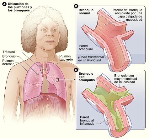 FFerrariOk's tweet photo. ¿Qué es la #bronquitis? https://t.co/iYeLJkasUv cc @ajv67 @jvalverde64 @RfaelCaballero @DrArmenta @MarianaLestelle https://t.co/GhL49FCOeD