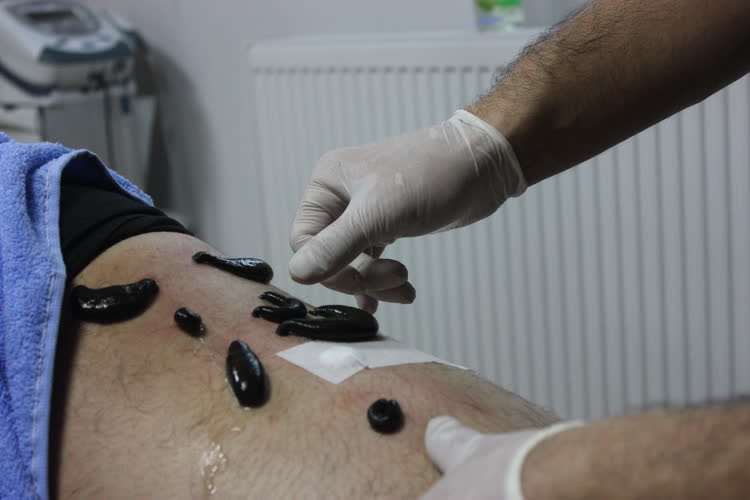 medicinalleech's tweet photo. Rıza Kayaalp sülük tedavisi nedeniyle sakatlığının iyileşme sürecinin hızlandığını kaydetti. #TıbbiSülük #sülük https://t.co/0RMaP3NeXp