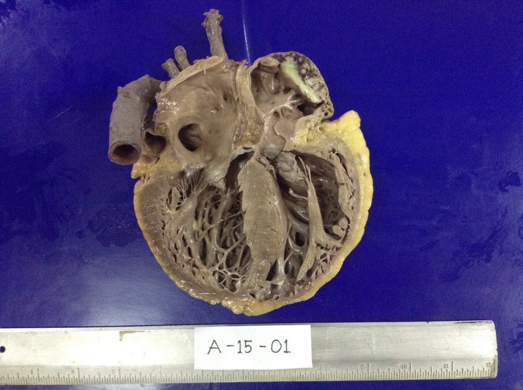iampathognome's tweet photo. Actual case of a nice dilated cardiomyopathy. #cardiovascularpathology #autopsy #philippineheartcenter https://t.co/e9Klbtg2UC
