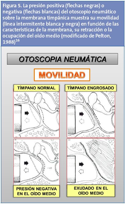 revistaPAP's tweet photo. #Otoscopia neumática https://t.co/Vhb9phU57N https://t.co/GYusdJy0Yn