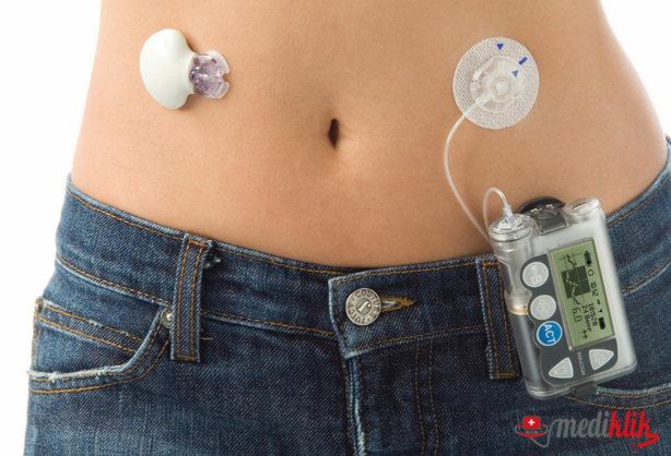 ashadidihealth's tweet photo. #Insulin Pump: A #Smart_Device To Revolutionize Diabetes Management.
https://t.co/I3zUl49LTH https://t.co/28sPY4pUDz