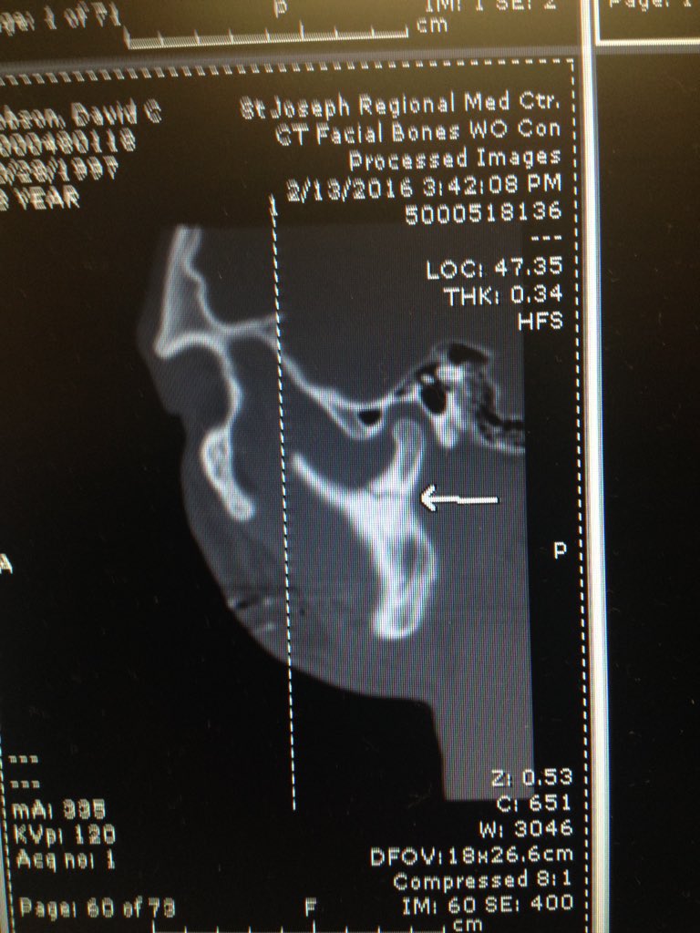 HobsonII's tweet photo. Fractured jawbone :) @RudderBSoccer @CoachWCompton @CoachPrimeaux https://t.co/DV6Yu3dGET