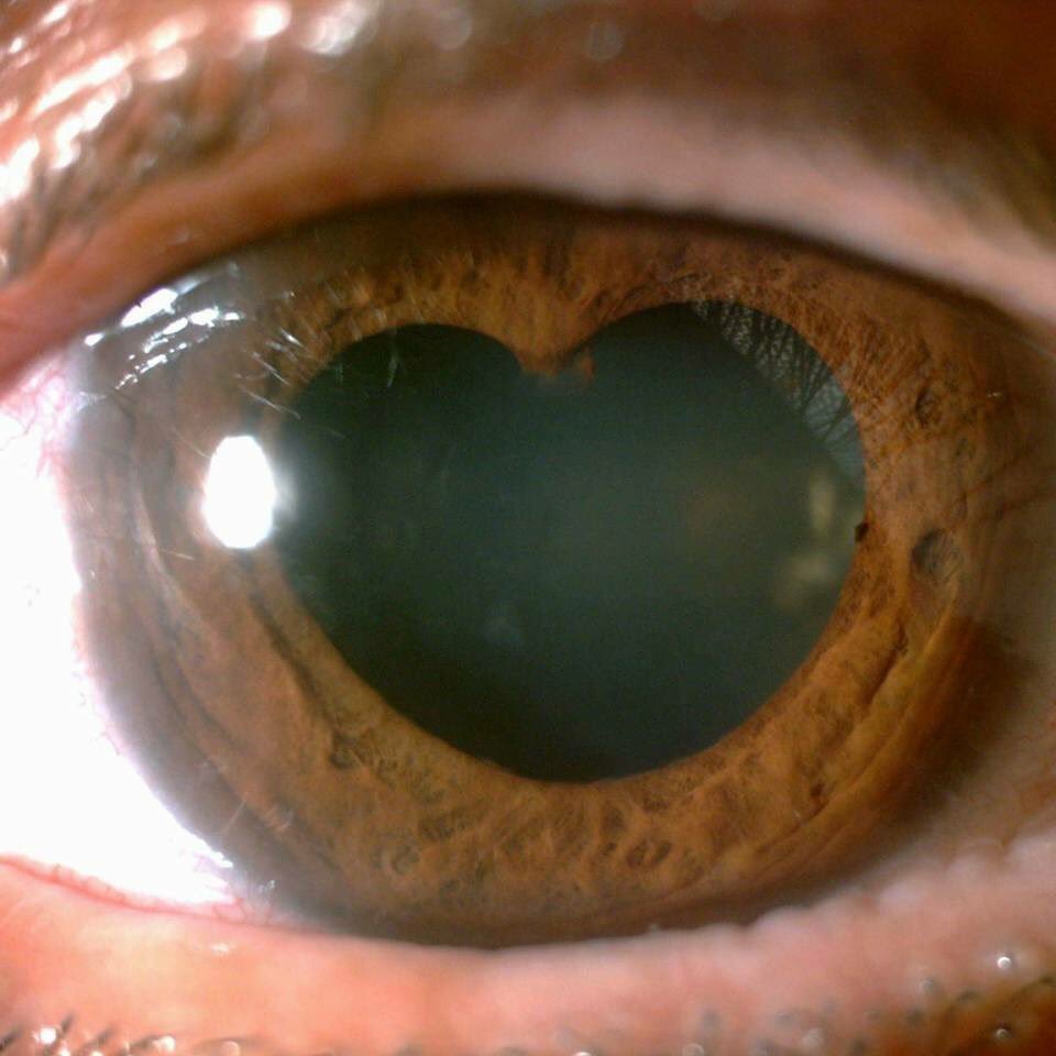 optometryportal's tweet photo. To all our fellow #optometry professionals....Have a great #ValentinesDay with your loved ones. 
#synechiae https://t.co/LJtAbl4bAc