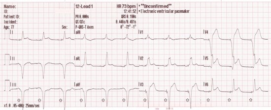 jemsconnect's tweet photo. Impossible to identify STEMI in presence of paced rhythm? We think not. https://t.co/FbJtft9JbN https://t.co/HvPlhb25nK