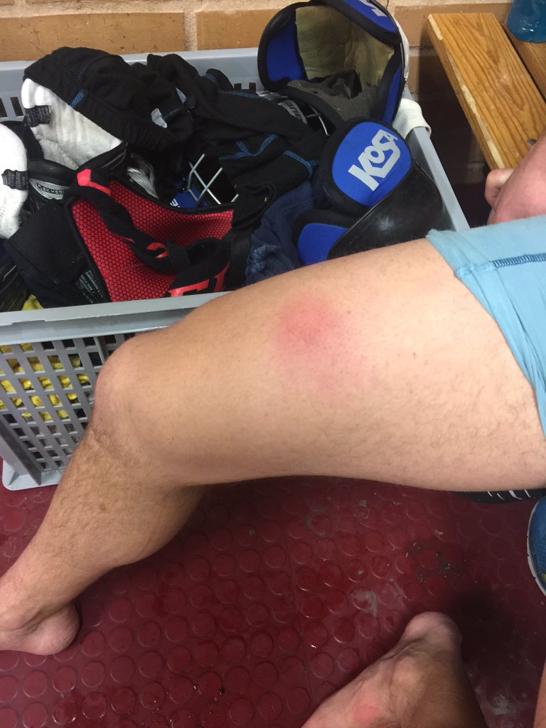 Här ser ni blåmärket som räddade matchen. 7-8 på Skarpe Nord. #bandyklubben #bandy #div1